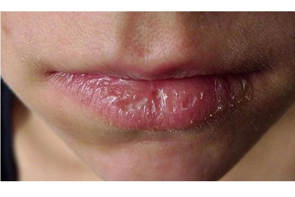 Viêm môi bong vảy, điều trị có khó