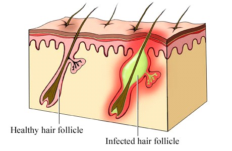 Viêm nang lông phải dùng thuốc thế nào?