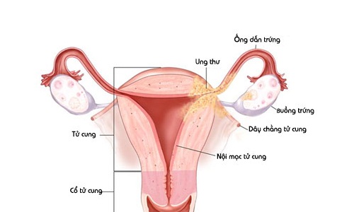 Thuốc điều trị lạc nội mạc tử cung ở phụ nữ