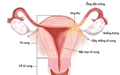 Chuẩn đoán và điều trị u nang buồng trứng