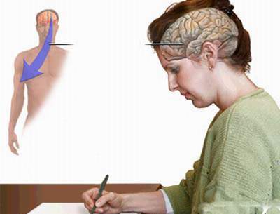  Tai biến mạch máu não khiến người bệnh mất khả năng viết. 