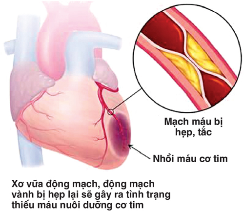 Thận trọng khi sử dụng nitroglycerin trong điều trị bệnh tim mạch 