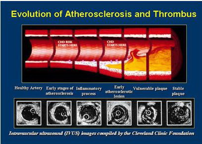 Hình ảnh siêu âm trong lòng mạch vành qua các giai đoạn vơ vữa 