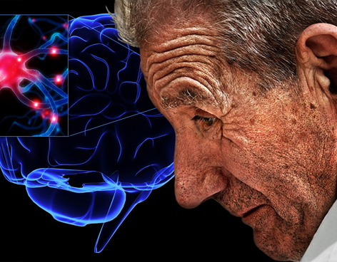 Chứng mất trí ở bệnh nhân Parkinson có thể được phát hiện sớm hơn
