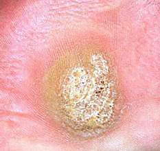 Mụn hạt cơm xuất hiện ở bất kỳ nơi nào trên da hoặc niêm mạc, thường có đường kính nhỏ hơn 0,5cm. Thời gian ủ bệnh trung bình từ 2 - 18 tháng. Hạt cơm thường không đáp ứng với bất kỳ dạng điều trị nào, nhưng chúng thường tự khỏi.