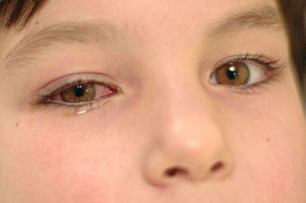 Cảnh giác với bệnh đau mắt đỏ ở trẻ em