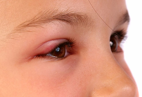 Viêm mi mắt, phòng và chữa bệnh thế nào?
