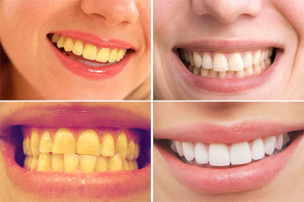 Răng đổi màu và giải pháp cho răng trắng đẹp