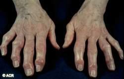 Tổn thương viêm khớp dạng thấp bàn tay là những nguyên nhân gây đau kiểu viêm. 
