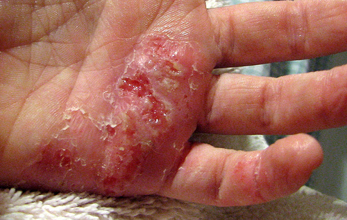 Eczema là gì, thuốc nào điều trị hiệu quả?