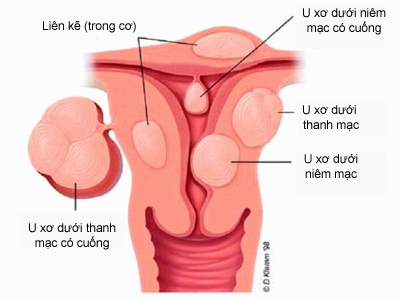 Thận trọng biến chứng của u xơ tử cung