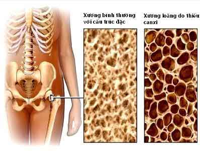 Cấu trúc xương ở người bình thường và người bị chứng loãng xương