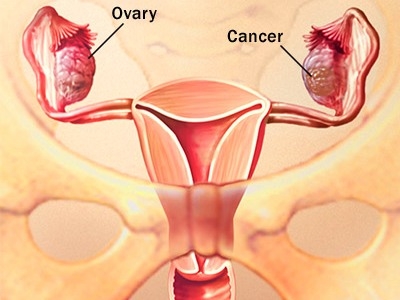 Phát hiện và chuẩn đoán ung thư buồng trứng