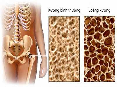Bệnh xốp xương-Hiểu đúng và phòng nhừa hiệu quả bệnh xốp xương