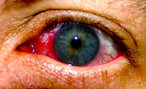 Đau mắt đỏ nên đùng thuốc nào?
