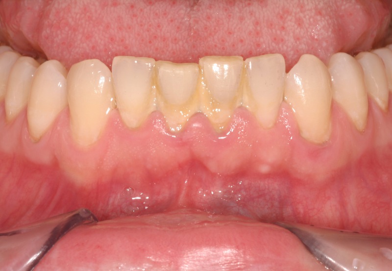 Cao răng hủy hoại sức khỏe răng miệng thế nào?