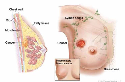 90% Chữa khỏi ung thư vú nếu được phát hiện sớm