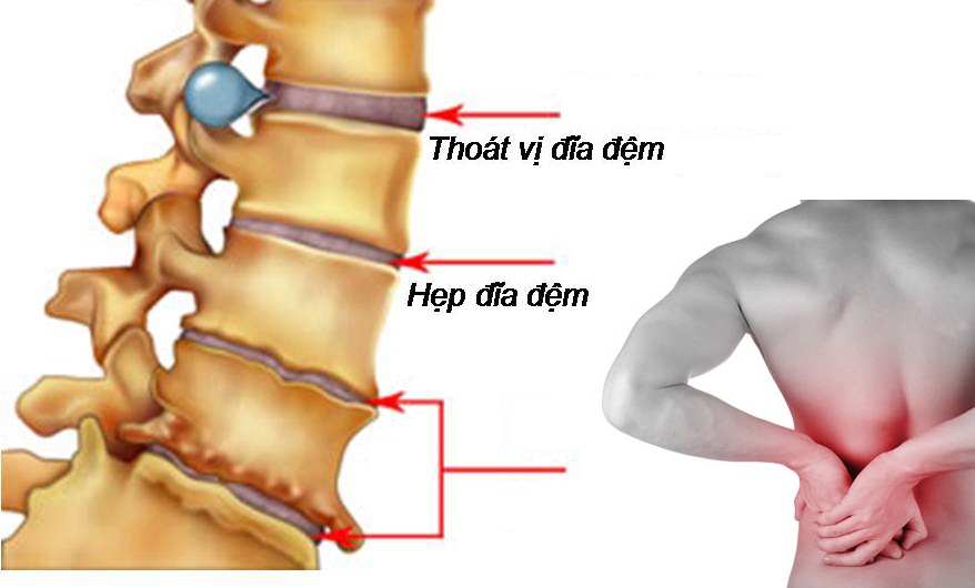 Điều trị đau thắt lưng có nguồn gốc từ đĩa đệm